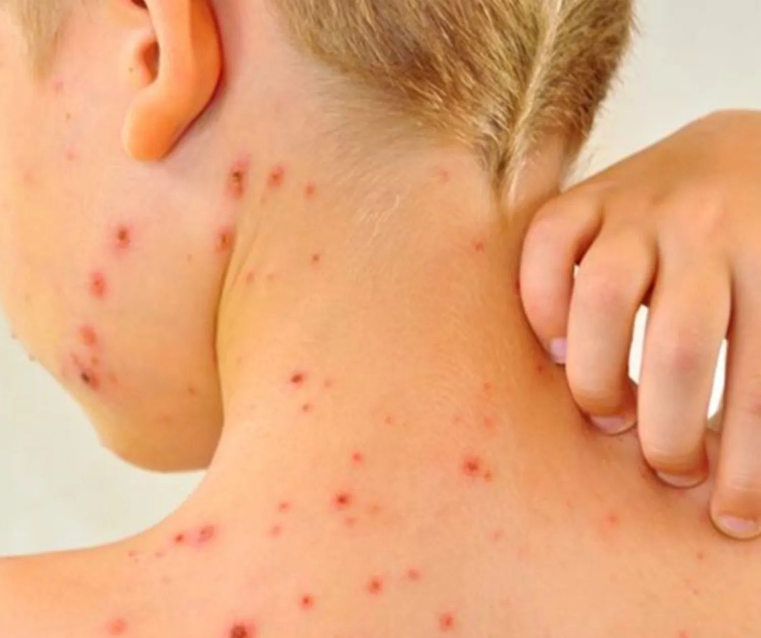 Más casos se sarampión en Paraguay 