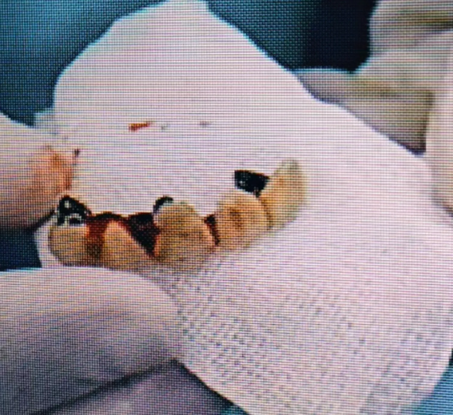 Hambre tragó su prótesis dental y quedó en el pulmón 